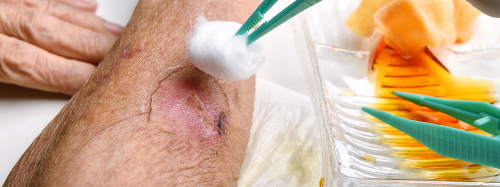 Wound Management Treatment in Faridabad